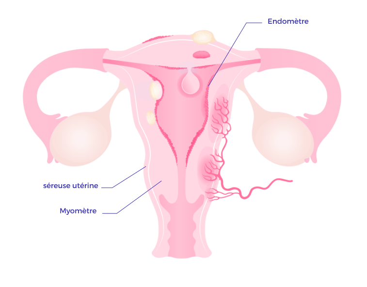 Schéma de l'utérus